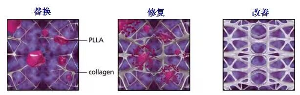 PLLA(聚左旋乳酸)全新科普